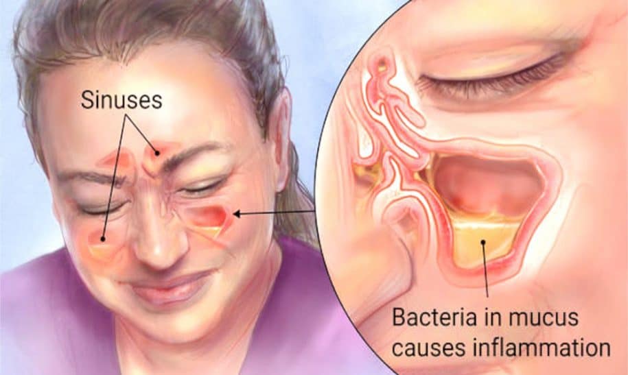 Kill Sinus Infections in 20 Seconds With This Simple Method and Common Household Ingredient
