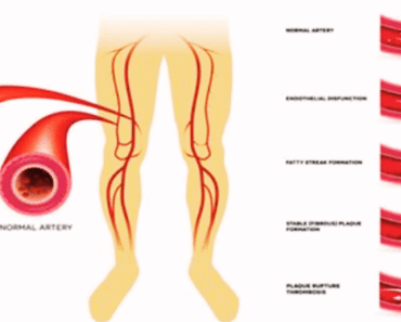 7 Natural Ways to Clear Your Arteries – No Pills, Just Results! 7 Natural Ways to Clear Your Arteries – No Pills, Just Results!