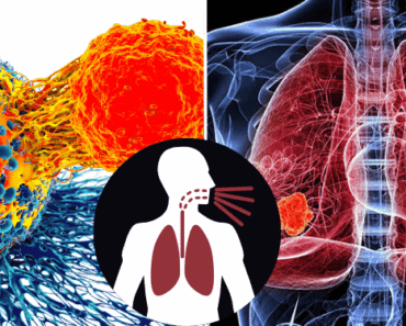 Doctors Sound Alarm: 6 Silent Lung Cancer Symptoms Most People Miss!